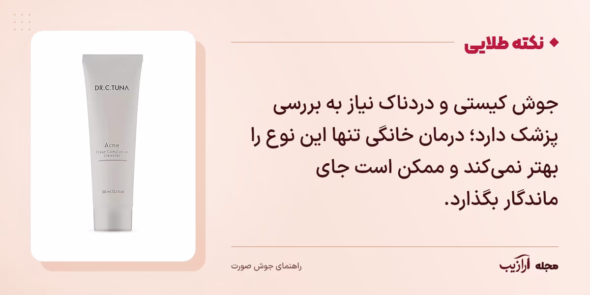 نکته طلایی جوش صورت: جوش کیستی و دردناک نیاز به بررسی پزشک دارد؛ درمان خانگی تنها این نوع را بهتر نمیکند و ممکن است جای ماندگار بگذارد.